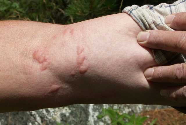 Cluster of red ant stings on human skin