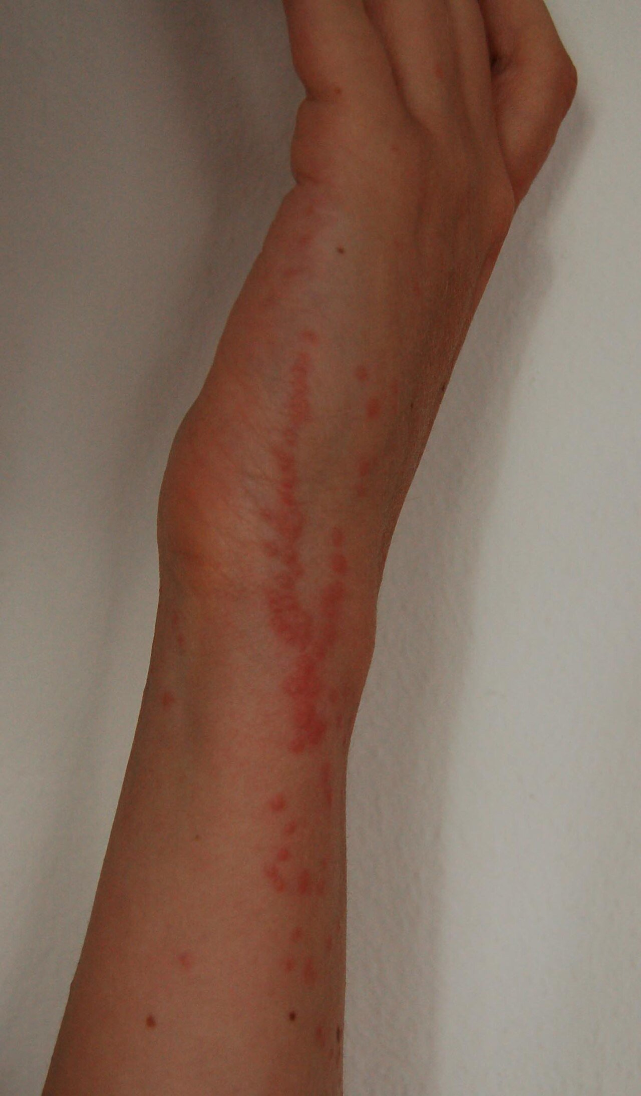 Bed bug bites clustered around a wrist — raised red welts on skin that was exposed above the covers